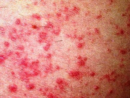 Atópiás dermatitisz (endogén ekcéma)
