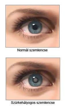Cataracta