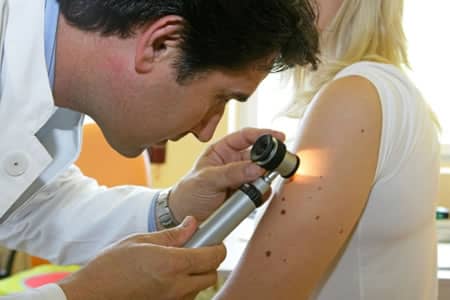 Melanoma-para
