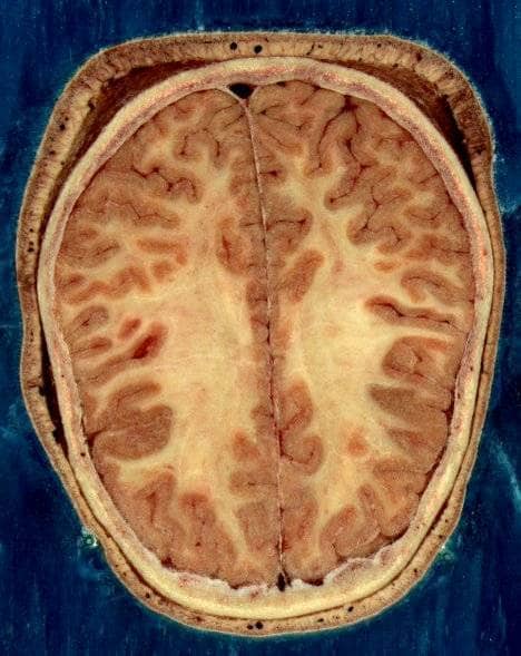 Myatrophiás lateralsclerosis