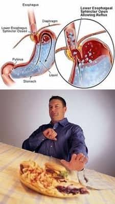 Gyomorégés (reflux)