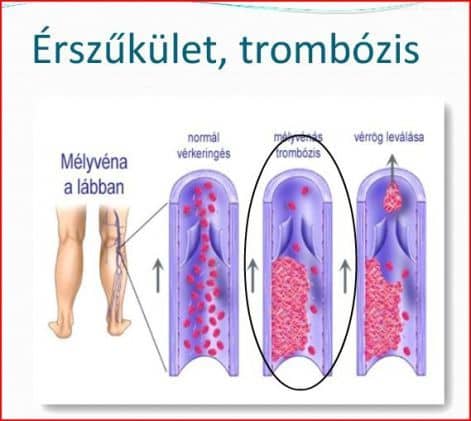 Vérrögképződés