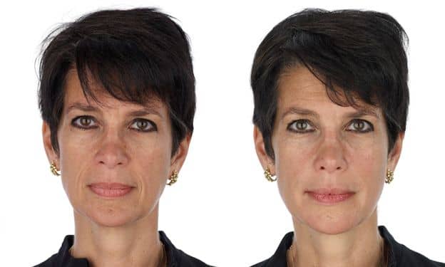 Vámpír szérum kezelés – Drakula terápia azaz bőrfiatalítás saját anyaggal