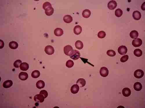 Candida albicans &#8211; élesztő szindróma