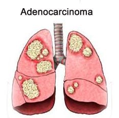 Adenocarcinoma