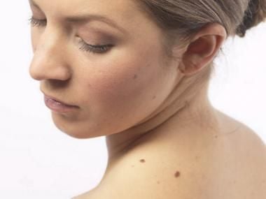 Az anyajegy, barát vagy ellenség?