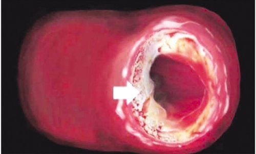 Az érelmeszesedésben szenvedő betegek étrendje