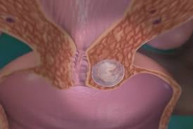 Méhen kívüli terhesség