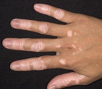 Részvét helyett elfogadhatóság mindenkinél