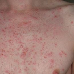 Mosópor allergia