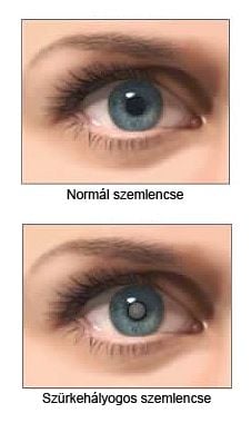 Cataracta