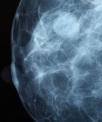 A mellműtét szövődménye: a tokfibrosis