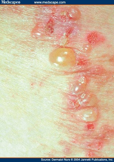 Dermatitis herpetiformis