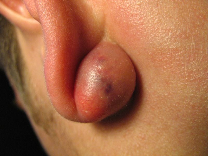 Atheroma