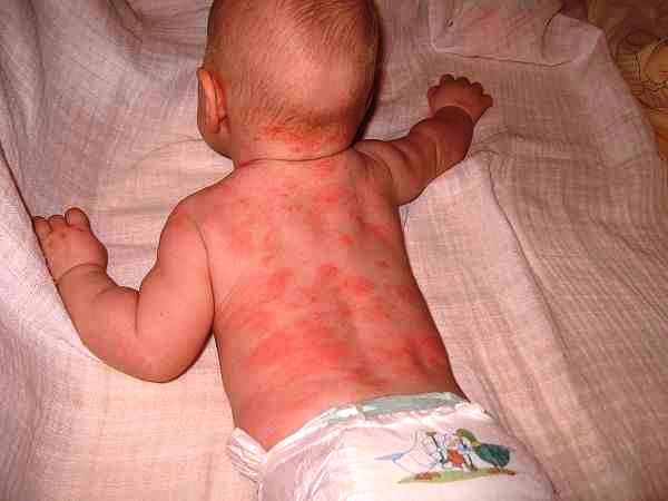 fizikai hatások által kiváltott csalánbetegségek