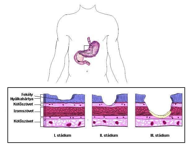 Elkerülhető a fájdalom megjelenése, a stressz elkerülésével?