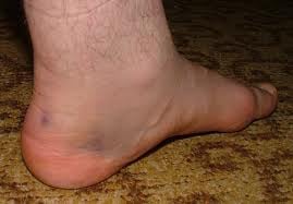 Achilles-ín-szakadás