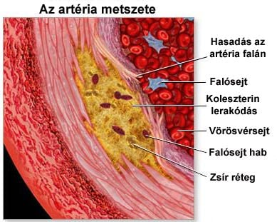 A magas koleszterinszint