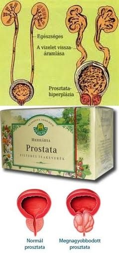 Prosztata- megnagyobbodás