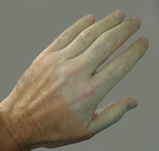 Raynaud-kór