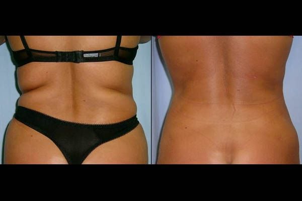 A zsírszövet eltávolítása