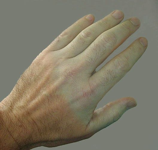 Raynaud-kór